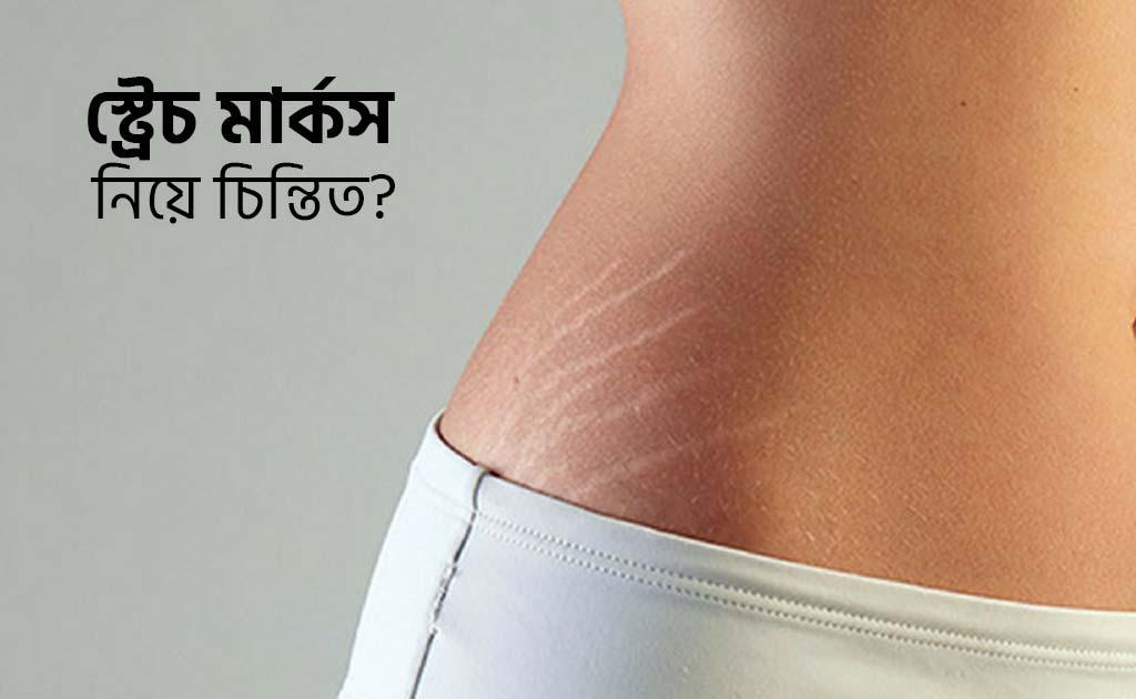 স্ট্রেচ মার্কস নিয়ে চিন্তিত?